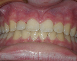 Cosmetic Resoration - After photo