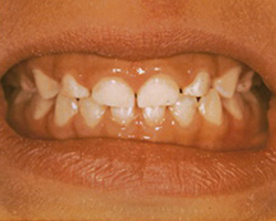 Black teeth stain removed - After photo