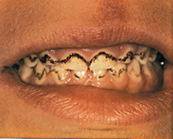 Black teeth staining - Before photo