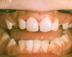 Fractured incisor - After photo