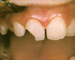 Fractured incisor - Before photo